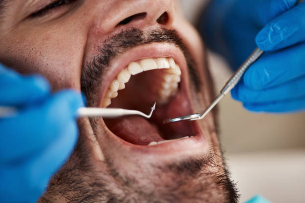 Best Emergency Treatment for Dental Infections or Abscesses in West York, PA