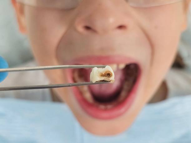 Best Urgent Care for Lost Fillings or Crowns in West York, PA